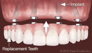 Dental Implants Replace All Teeth Tampa