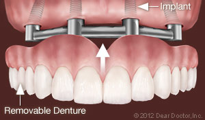 Dental Implants Support Removable Dentures Tampa, FL